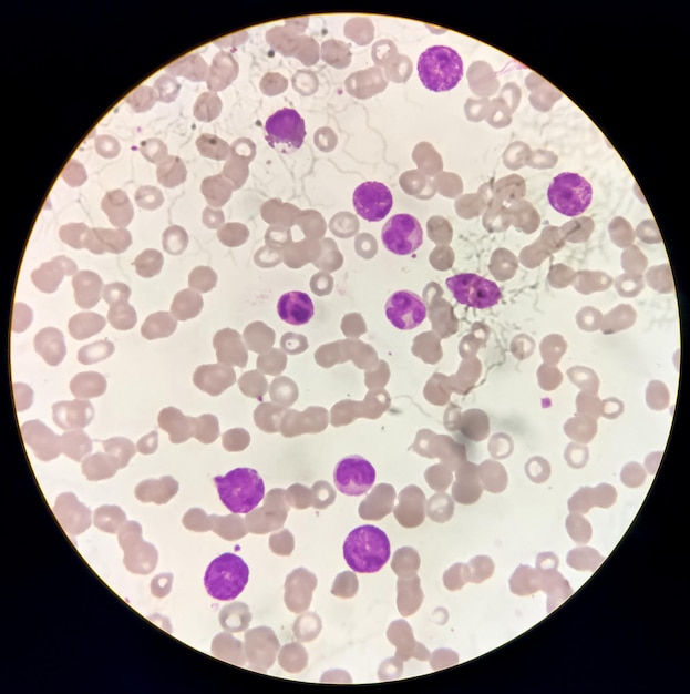 Foto células de leucemia mieloide crónica o lmc, analizadas al microscopio, imagen original de 400 aumentos.