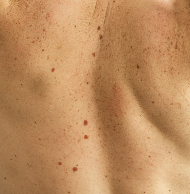 Foto de cerca los detalles de la piel desnuda de la espalda de un hombre con lunares y pecas dispersos. comprobación de lunares benignos