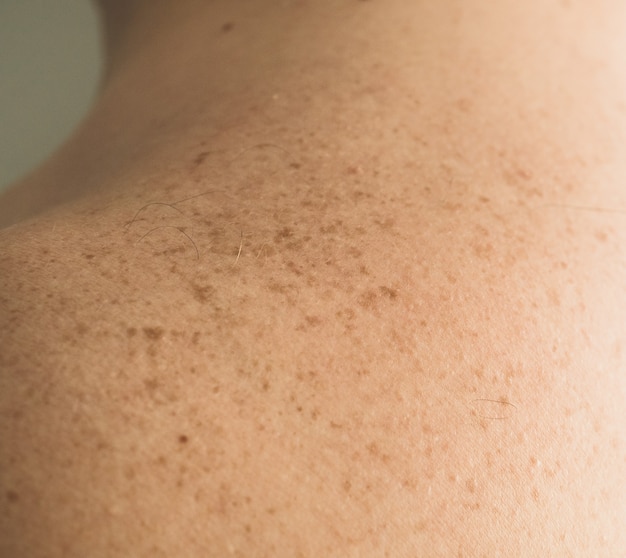 De cerca los detalles de la piel desnuda de la espalda de un hombre con lunares y pecas dispersos. Comprobación de lunares benignos