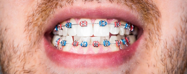 Cerca de las llaves de los dientes en los dientes blancos del hombre para igualar los dientes Concepto dental