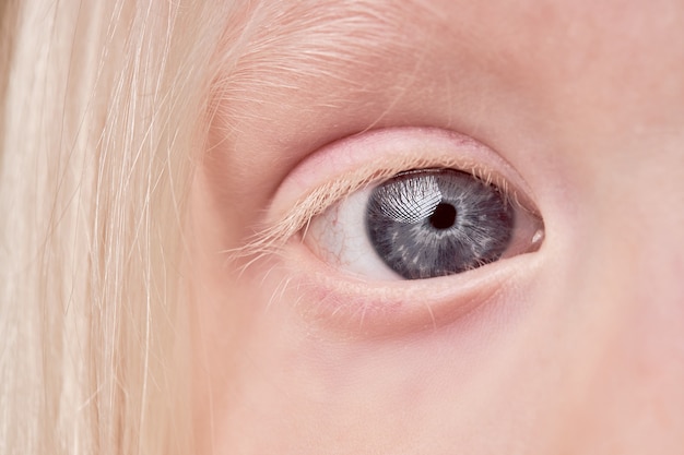 Cerca de niño albino con ojos, cejas y pestañas inusuales de color