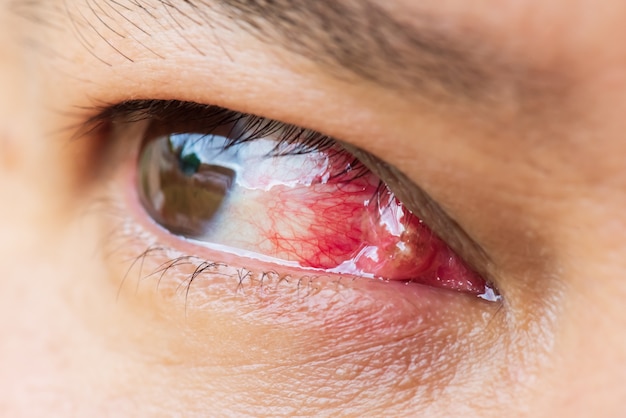 Cerca del pterigión durante el examen ocular. Concepto de salud.