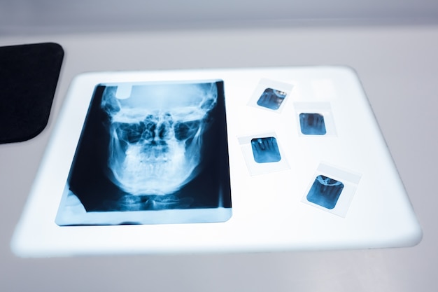 Cerca de una radiografía de un cráneo humano sobre la mesa