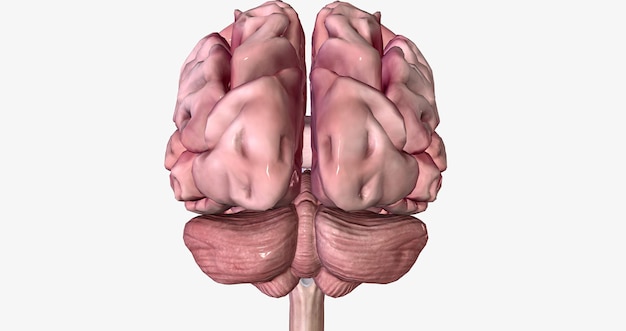 Cérebro com doença de Alzheimer grave