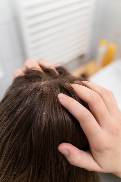 Cerrar el cabello con caspa