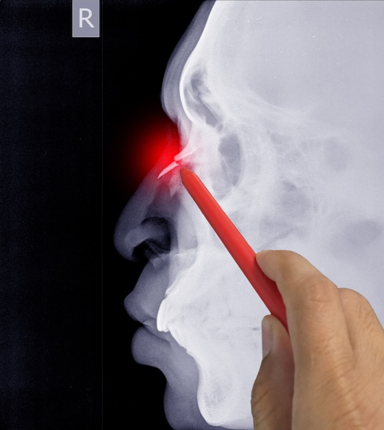 Cerrar el hueso nasal de rayos X lateral que muestra la fractura del hueso nasal, médico sosteniendo un punto de lápiz rojo, síntomas concepto de salud médica.