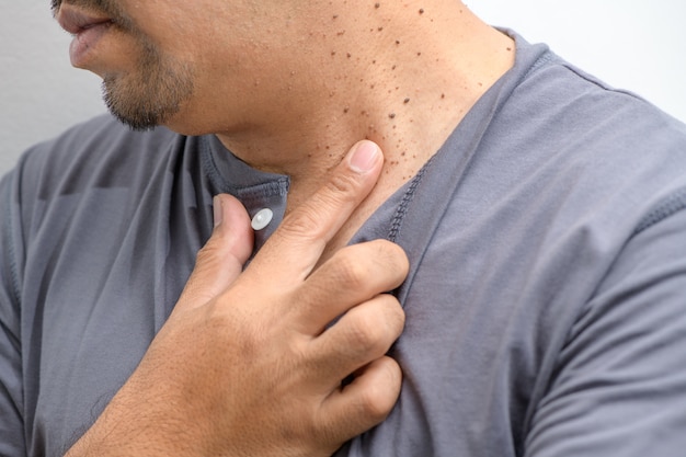 Cerró las etiquetas de piel o acrocordón en el cuello del hombre sobre fondo blanco.