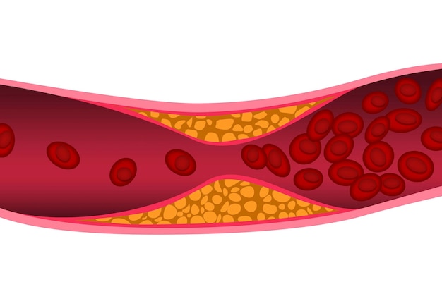 Cholesterin in der Arterie Medizinisches Konzept