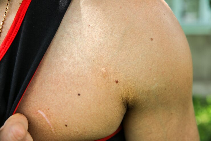 Foto cicatriz antiga no peito do homem. acidente no passado.