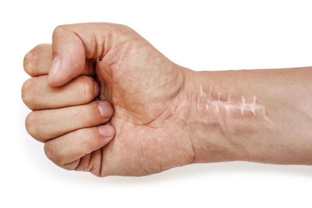 Cicatriz com pontos no pulso após a cirurgia Fratura dos ossos das mãos em punho isolado em fundo branco