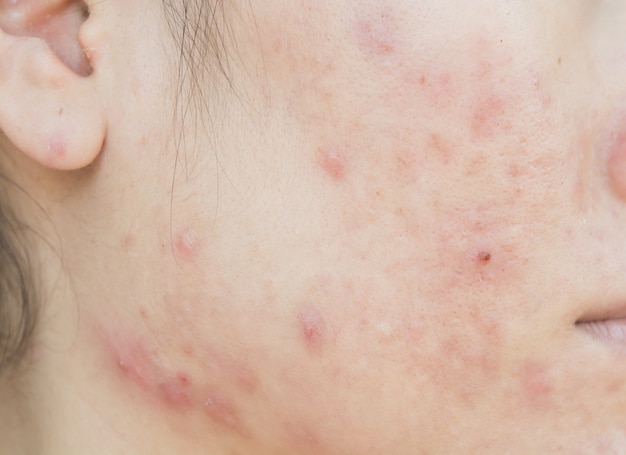 Foto cicatriz da acne no rosto e problema de pele