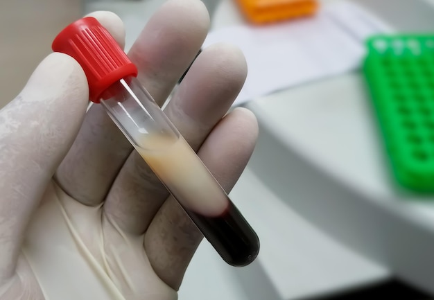 Foto cientista ou bioquímico segura tubo de ensaio com amostra de sangue lipêmica.