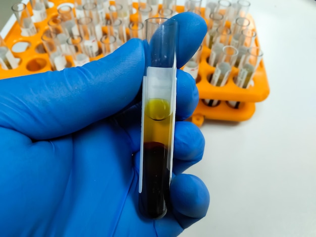 Cientista segurando tubo de amostra de sangue de soro de hiperbilirrubinemia para teste de bilirrubina. Teste de icterícia