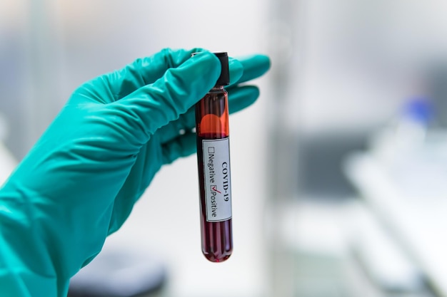 Cientista segurando tubo de ensaio com amostra de sangue para teste COVID19Experiência para detectar vírus foi encontrada no sangue