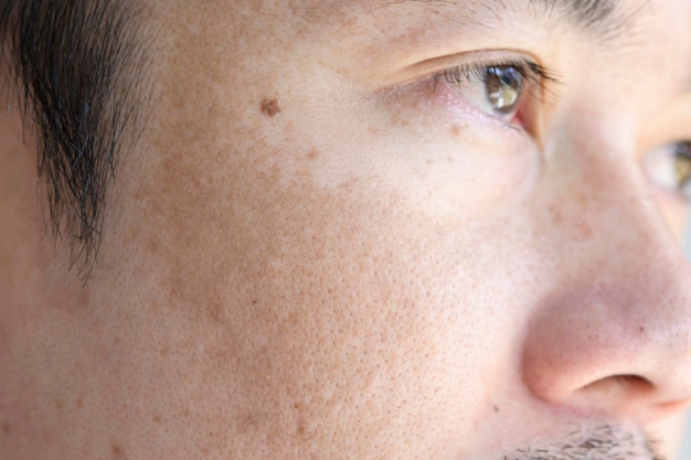 Cierra la cara del hombre asiático con pecas manchas oscuras del cuidado de la piel con luz ultravioleta y el concepto de problema de salud