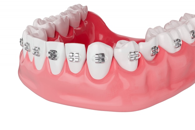 Ciérrese encima de los dientes de la salud de la belleza con la abrazadera. Enfoque selectivo. Renderizado 3D