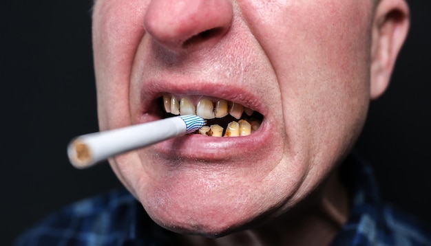 Cigarro na boca do homem Placa cárie dentária e paradontose Fumar causa problemas de cárie dentária e sorriso ruim Conceito de tratamento de dentista Hábito prejudicial