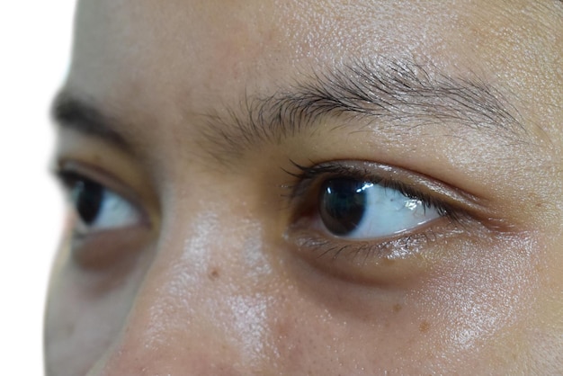 Círculos escuros ao redor dos olhos da mulher asiática Descoloração marrom das pálpebras
