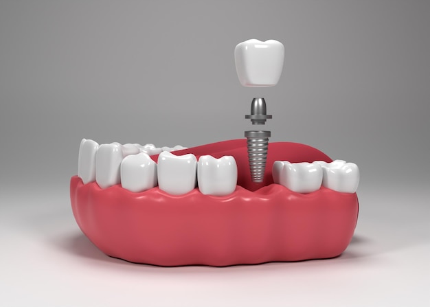 Cirugía de implantes dentales renderizado 3d