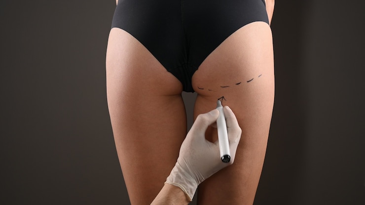 Foto cirujano plástico marcando el cuerpo de la mujer para cirugía