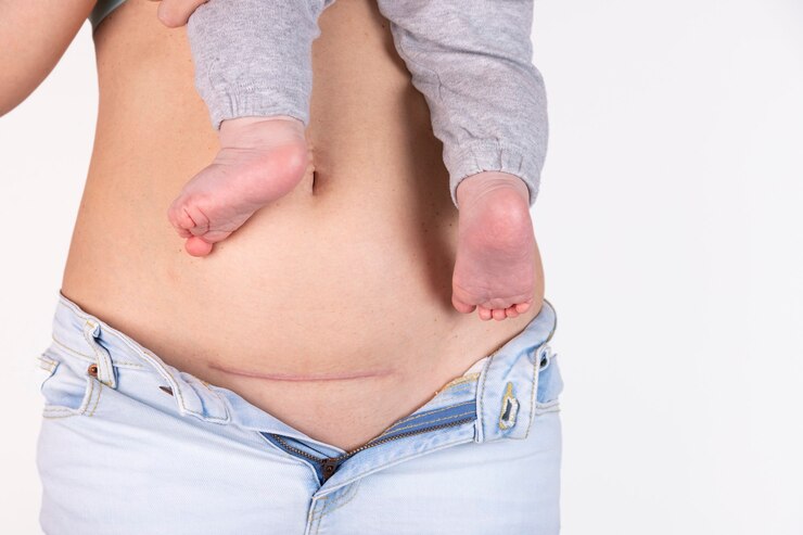 Foto close da barriga de uma mulher com cicatriz de cesariana, cinco meses após o parto