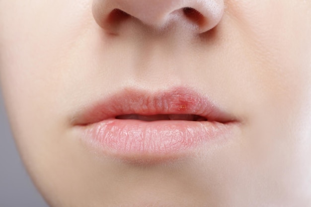 Close de lábios humanos afetados por herpes labial