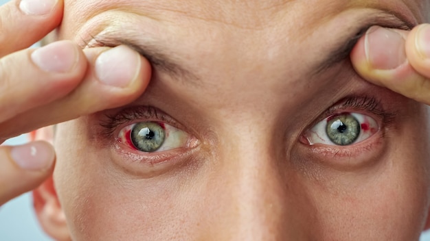 Close de um homem com olhos feridos e vermelhos, levantando as pálpebras com os dedos olhando para a câmera