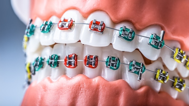 Close de um modelo ortodôntico de maxilares e dentes com aparelho.