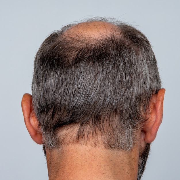 Close de uma cabeça de homem meio careca, conceito de transplante de cabelo para queda de cabelo