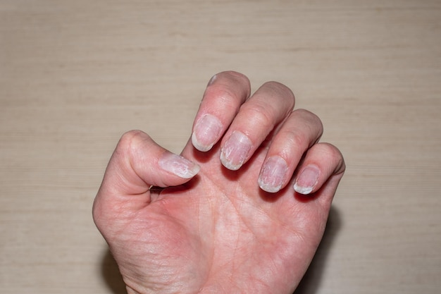 Close de unhas roídas e quebradiças, sem manicure. Unhas com cutículas crescidas e placa ungueal manchada. Cutícula unha com crescimento excessivo e placa ungueal danificada. Conceito de cuidados com as unhas e saúde.