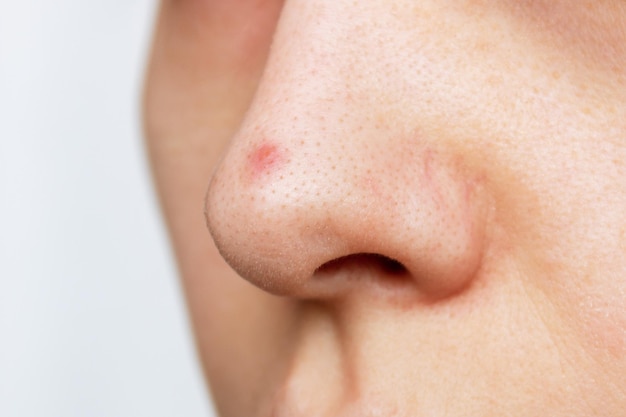 Close do nariz de uma mulher com cravos ou pontos pretos e um problema de acne com espinhas vermelhas inflamadas