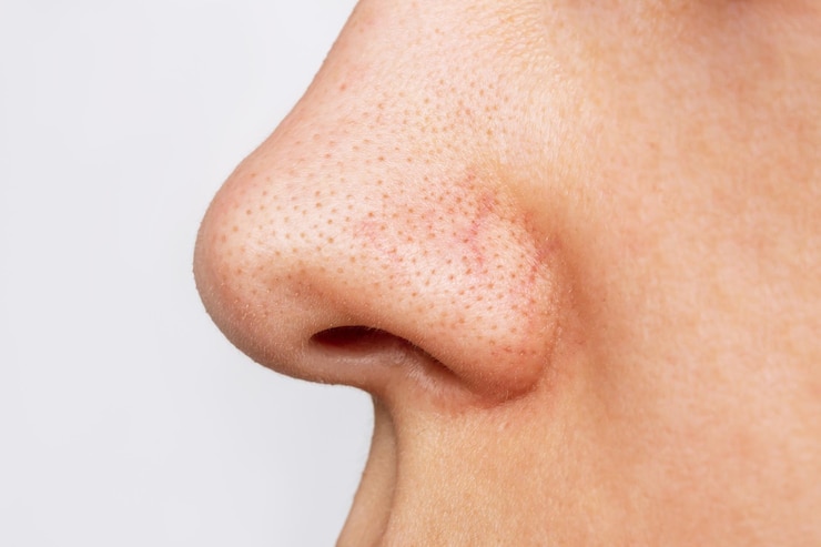 Foto close do nariz de uma mulher com cravos pretos ou pontos pretos com problemas de acne comedões poros dilatados