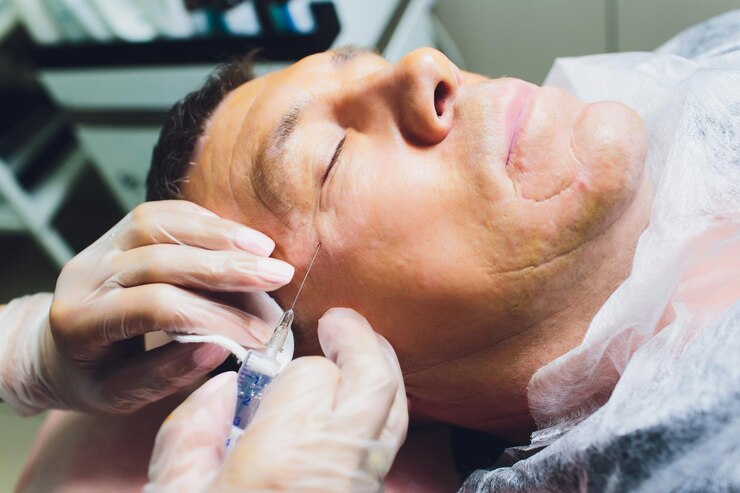 Foto close do procedimento para lifting facial operação de sutura pdo cirurgia de lifting facial técnica inovadora