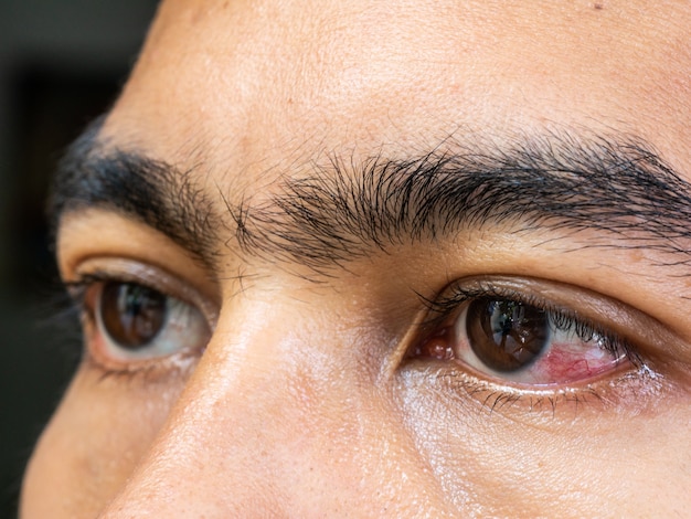 Close dos olhos irritados de um homem afetado por conjuntivite