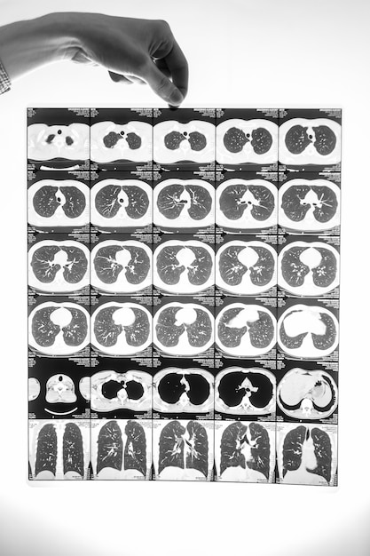 Foto close em preto e branco de um homem segurando um filme com o resultado da tomografia dos pulmões