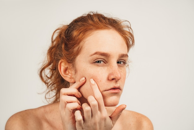 Close-up cara beleza natural ruiva mulher bonita com sardas luta com acne.