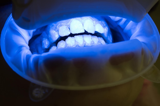 Close-up da boca feminina Combinando os tons dos implantes ou o processo de clareamento dos dentes Dentista com assistente em um uniforme descartável em uma clínica odontológica moderna