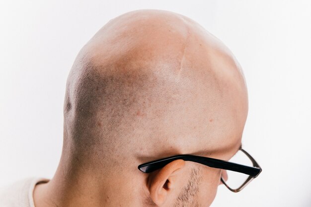 Close up da cabeça masculina careca após a operação de oncologia.