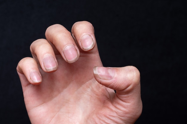 Close-up da mão feminina caucasiana com unhas quebradiças sujas, unhas quebradas em um fundo preto. Descamação nas unhas