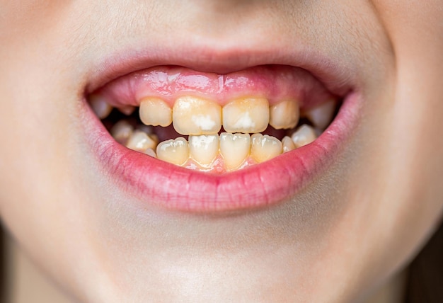 Foto close-up de dentes de leite insalubres boca aberta de um menino com dentes em crescimento inadequado