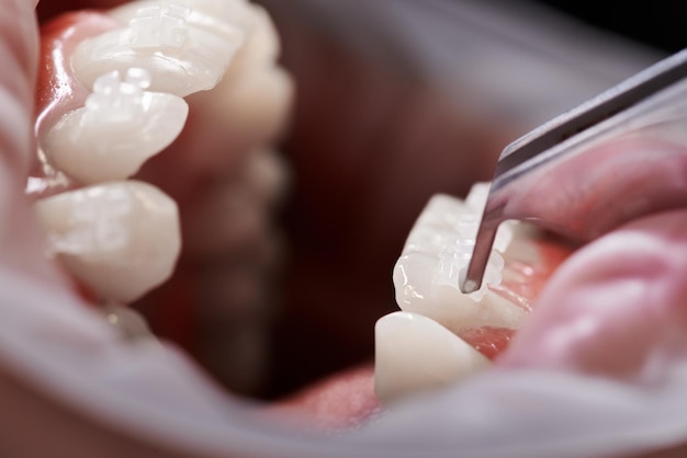 Close-up de especialista em odontologia instalando suportes ortodônticos nos dentes do paciente Pessoa com aparelho nos dentes tendo procedimento odontológico na clínica Conceito de estomatologia e tratamento ortodôntico