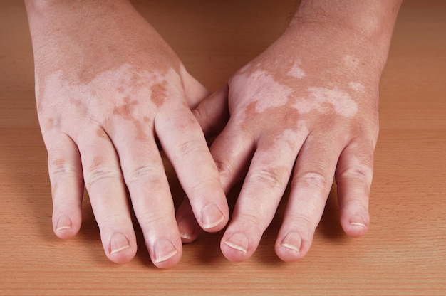 Foto close-up de mãos com vitiligo