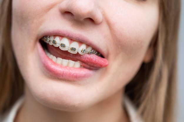 Foto close-up de mulher com aparelhos dentários