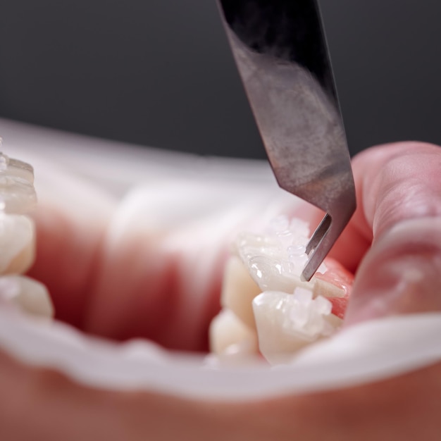 Close-up de ortodontista colocando suportes ortodônticos nos dentes do paciente Pessoa com suportes em dentes brancos tendo procedimento dentário na clínica Conceito de estomatologia e tratamento ortodôntico