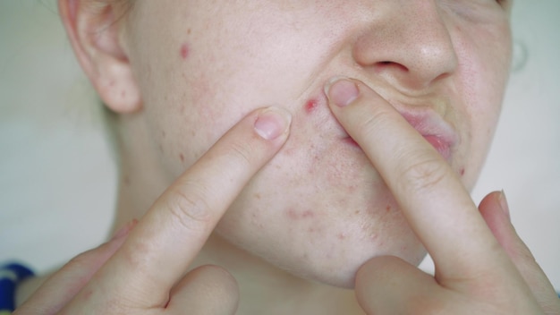 Close-up de problemas de pele pele insalubre com acne e espinhas Demodex poroso e rosácea erupções vermelhas O conceito de cuidado para a pele problemática Alérgica e vermelhidão
