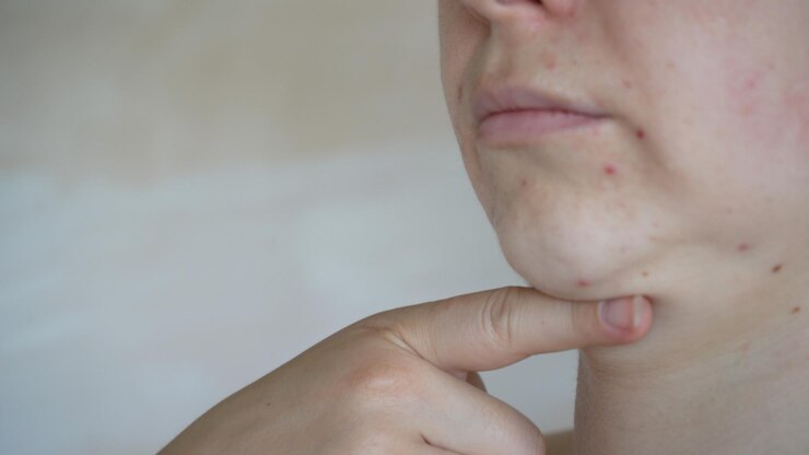 Foto close-up de problemas de pele pele insalubre com acne e espinhas demodex poroso e rosácea erupções vermelhas o conceito de cuidado para a pele problemática alérgica e vermelhidão