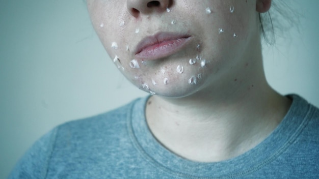 Foto close-up de problemas de pele pele insalubre com acne e espinhas demodex poroso e rosácea erupções vermelhas o conceito de cuidado para a pele problemática alérgica e vermelhidão