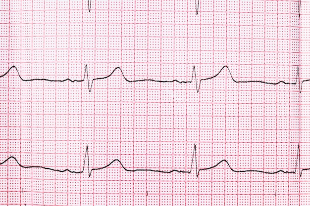 Foto close up de um eletrocardiograma em papel