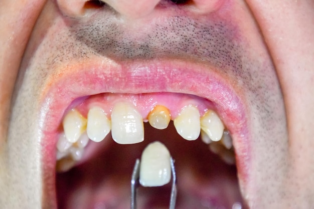 Foto close-up de um homem segurando dentes