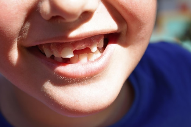 Close-up de um menino com dentes espaçados